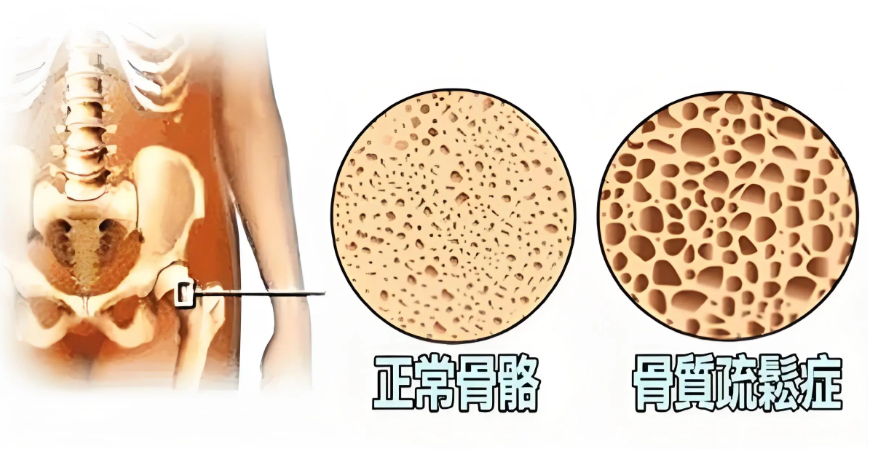 身体变脆只是心理暗示？1分钟测出骨骼老化背后的隐秘危机