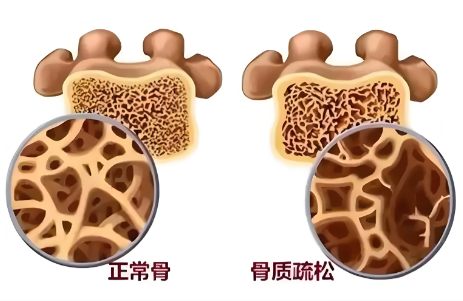 一磕碰就担心骨折？测测你的骨骼健康是否已发出求救信号？
