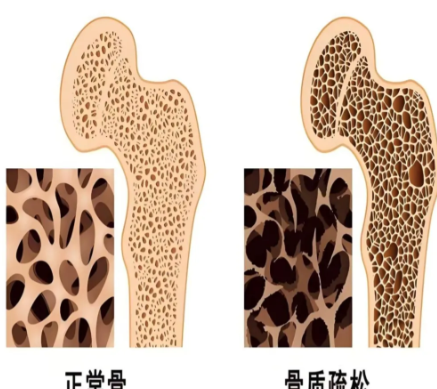 化解未老先衰焦虑,精准排查骨骼隐患,重塑挺拔自信身姿